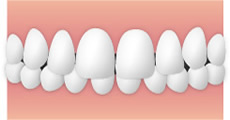 出っ歯（上顎前突-じょうがくぜんとつ）のイメージ
